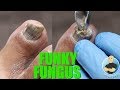 HAVE NAIL FUNGUS? YOU NEED TO BE DOING THIS!!!! ***SUPER IMPORTANT TIP***