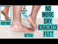 How to Get Rid of Dry Cracked Feet FAST & NATURALLY | AT HOME Remedies & MORE