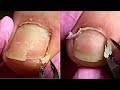 Monstrous Toenail Cleaning Transformation Dead Skin Removal How To Pedicure Tutorial 👣